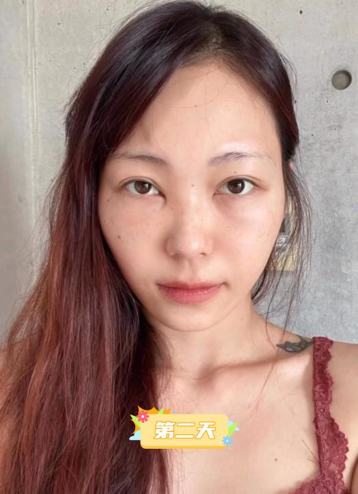 内切去眼袋手术全过程,做了去眼袋手术五天怎么还有眼袋