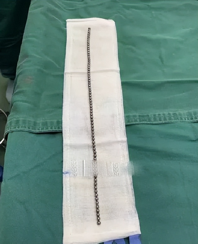 浙江14岁男孩体内取出19颗磁力珠,十一岁男孩吞磁珠