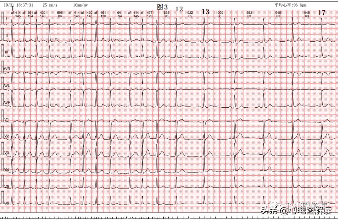 房性早搏和房颤会同时存在吗,频发房早会演变成房颤吗