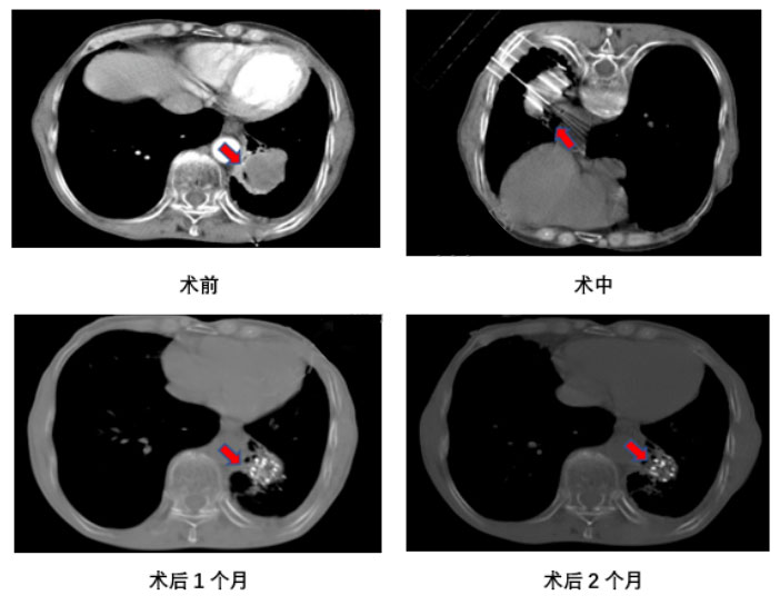 肿瘤治疗新方法----放射性粒子植入治疗