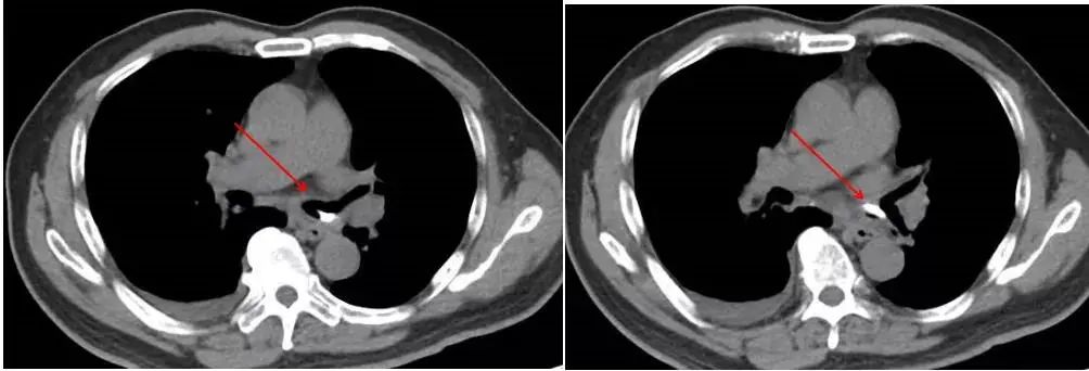喉管长了一个包怎么办,气管里总长痰栓怎么治疗