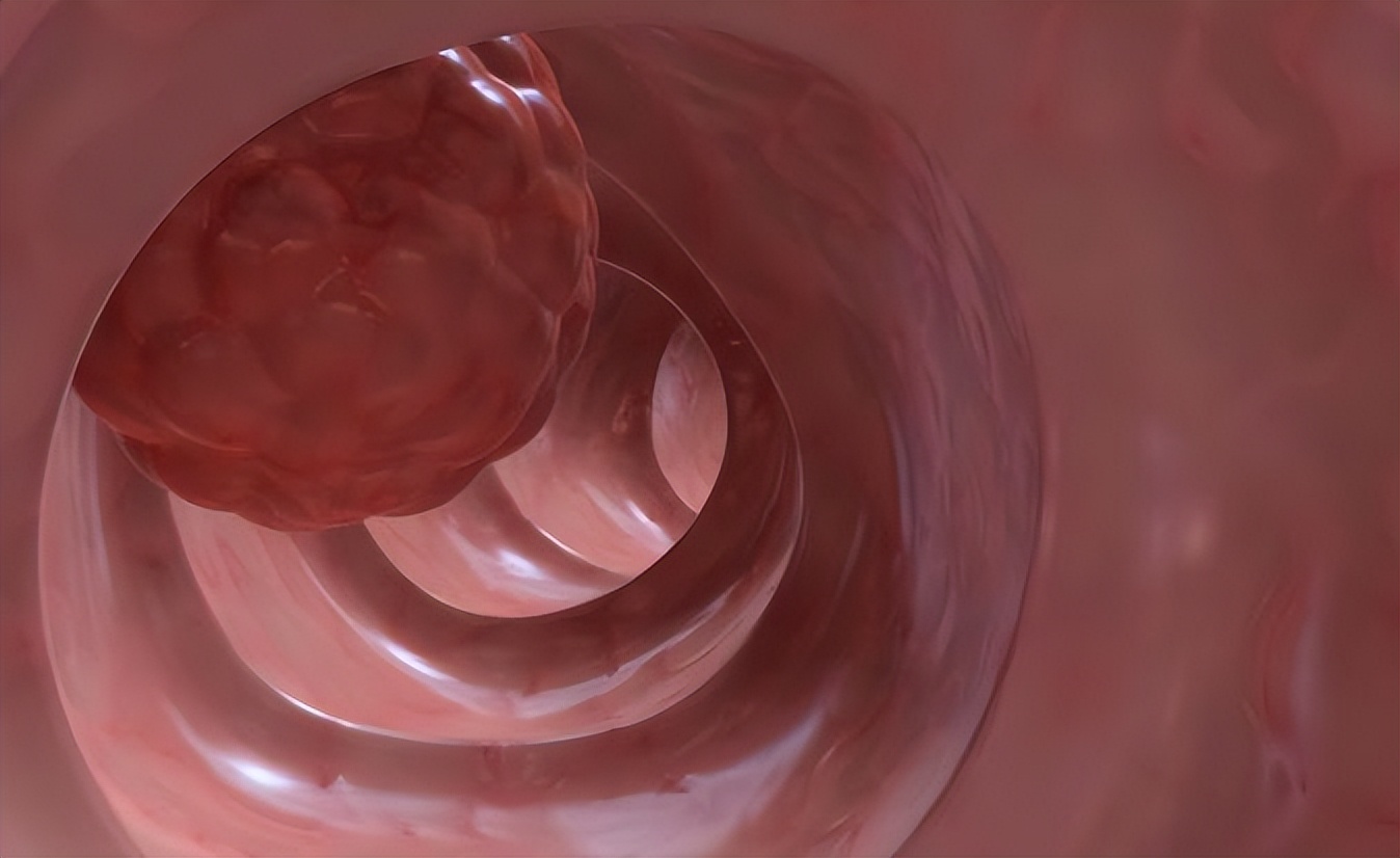 结直肠癌遗传几率高吗,结直肠癌有遗传吗