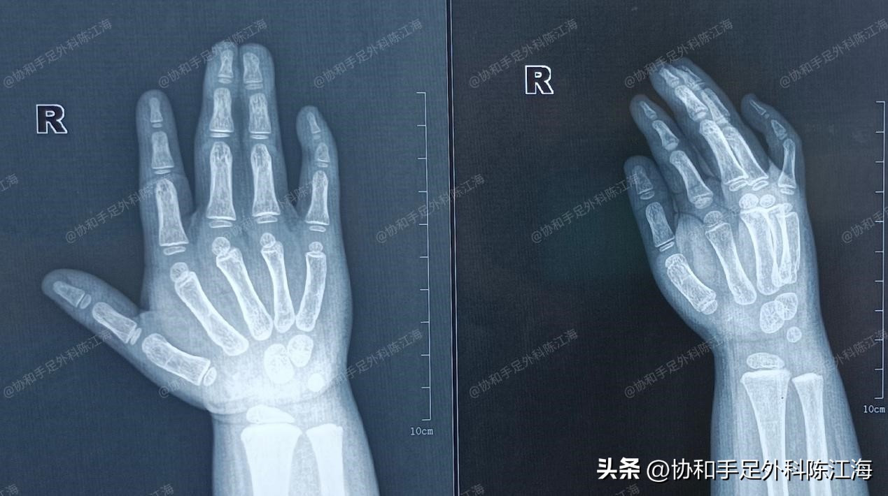 小孩多指并指免植皮新技术,儿童并指零植皮新方法