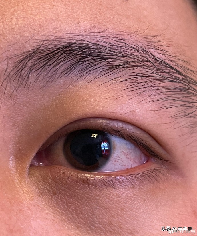 在新西兰做近视手术贵吗,在德国做近视手术费用多少