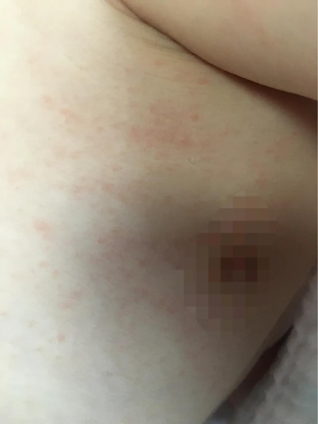 宝宝湿疹大作战,宝宝湿疹反复妈妈需要忌口什么