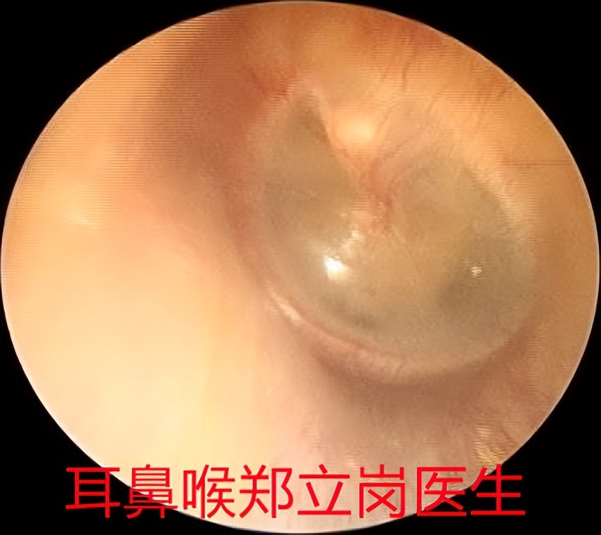 一侧耳朵闷堵听力下降可以自愈吗,突然耳朵堵住的感觉怎么解决