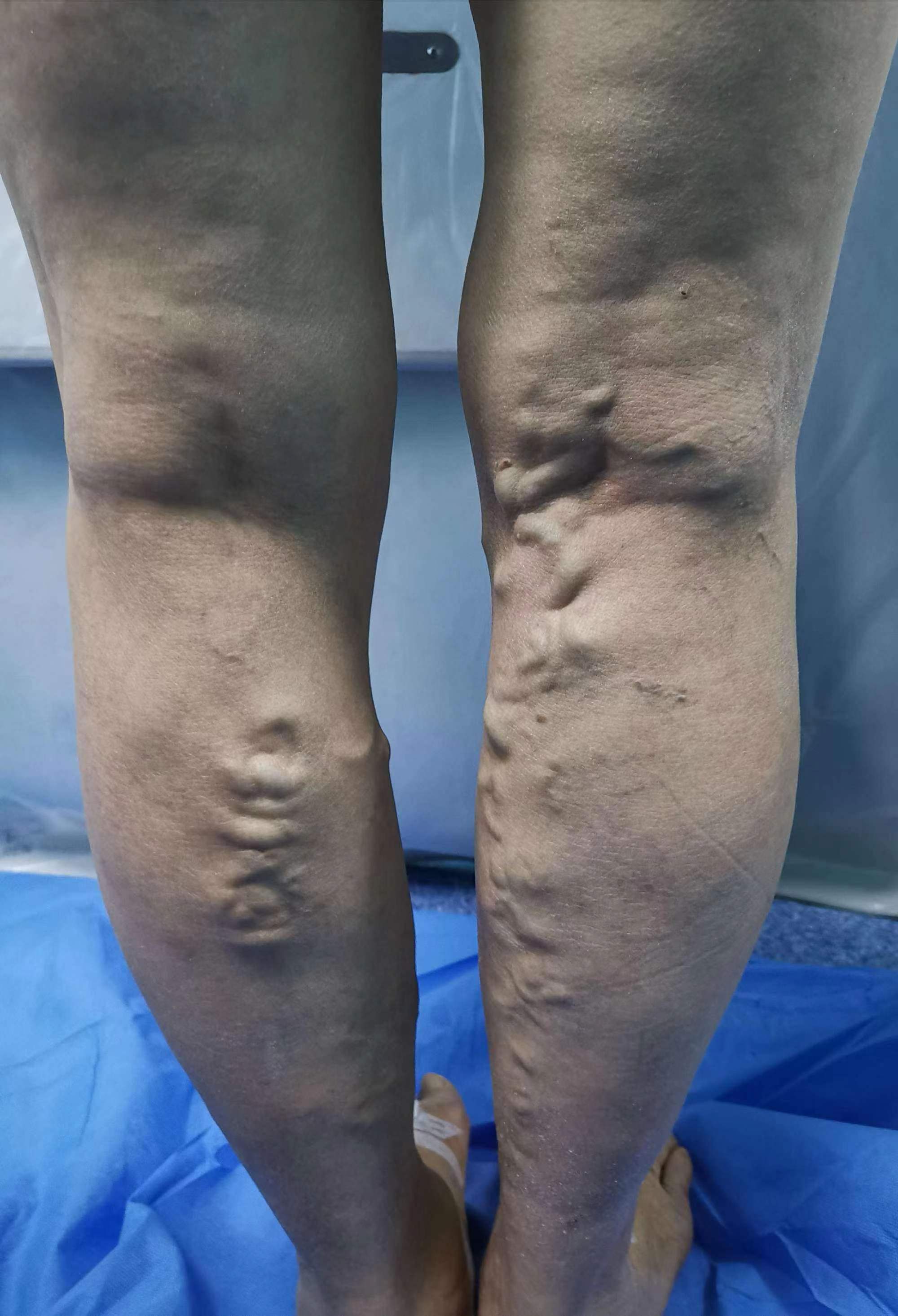 中药桂枝茯苓丸有什么副作用吗,桂枝茯苓丸中哪味药活血化瘀