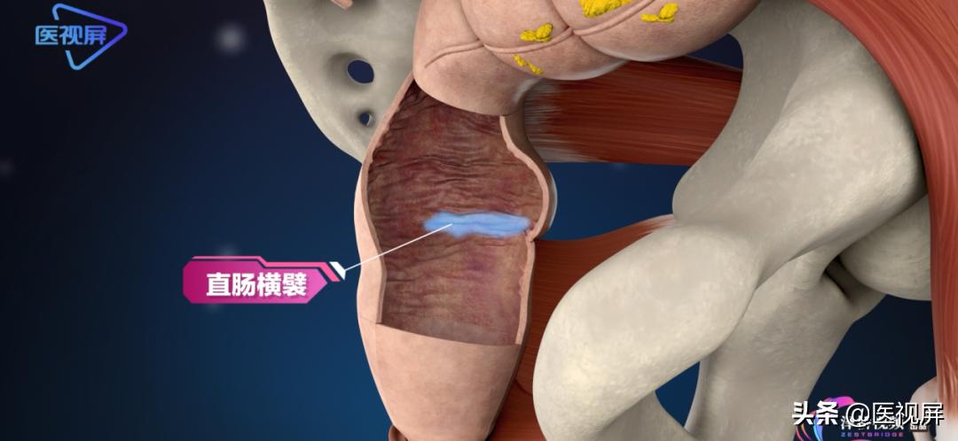 结肠肿瘤突变型多久长到15mm,直肠肿瘤长了23年