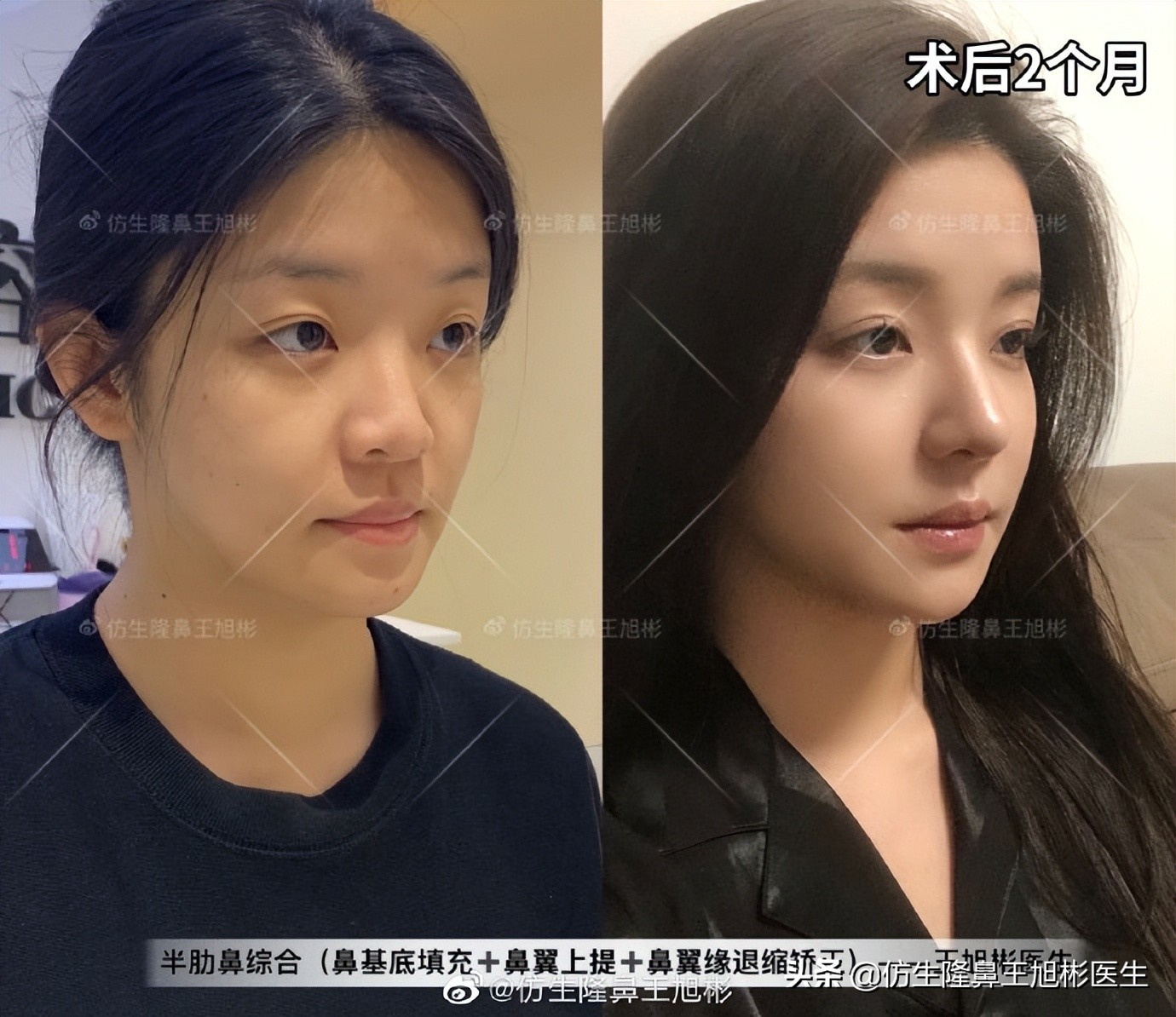 可以只做鼻头不放假体吗,只做鼻头鼻翼缩小手术多少钱