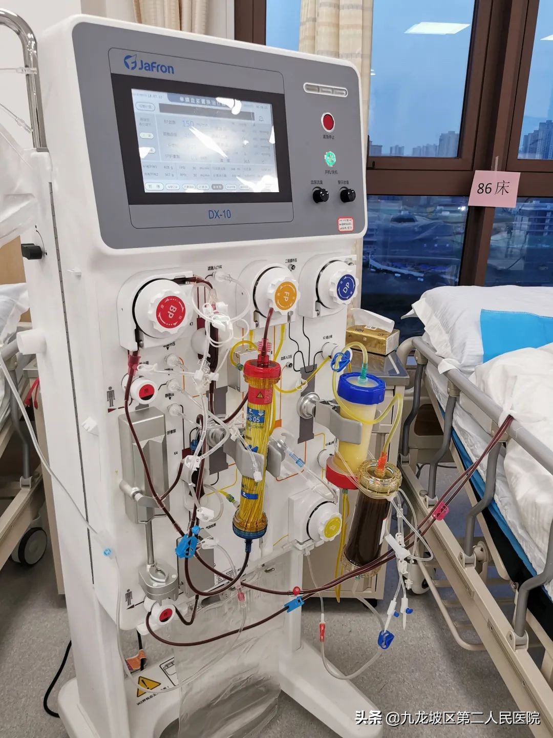 血液净化中心护理视频,人工肝血液净化治好肝硬化