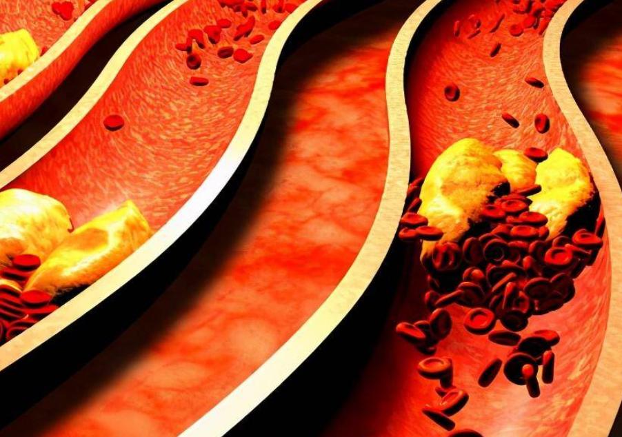 中医治疗心力衰竭效果好吗,中医对心力衰竭是如何辨证