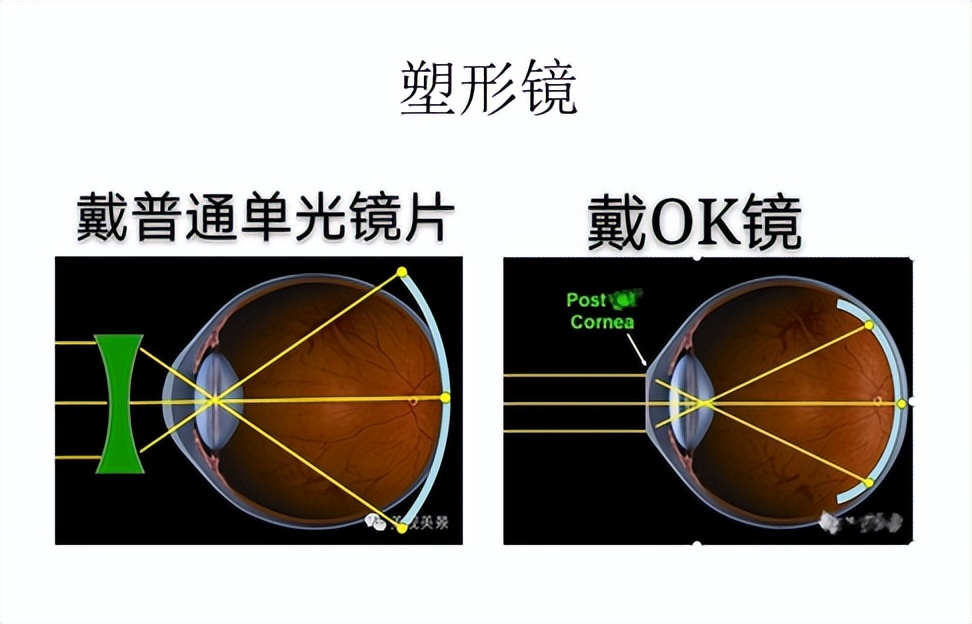 孩子近视最好的解决方案,孩子近视200多度到底怎么治疗好