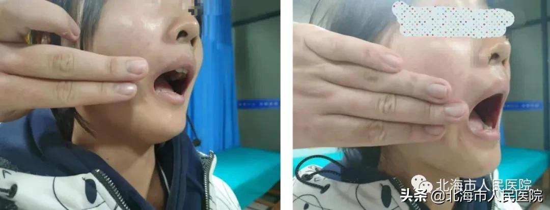 15岁女孩的嘴巴张不开怎么办,女孩患病张不开嘴