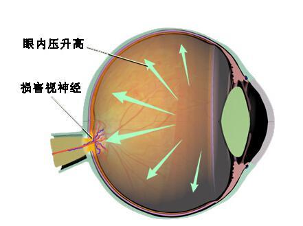 治疗青光眼的复合眼药水,乙酰唑胺治疗青光眼怎么吃