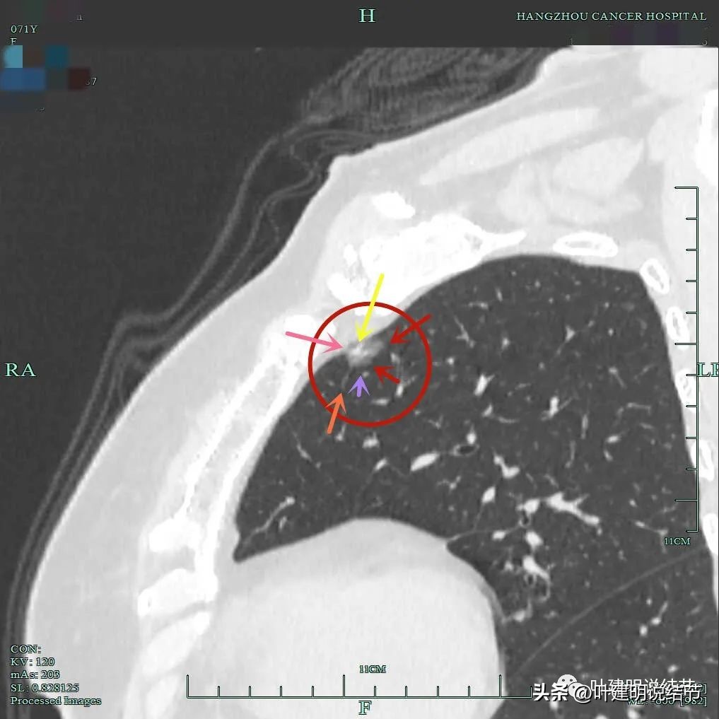 右下叶磨玻璃6mm结节基本上是癌,右下叶少许炎症上叶磨玻璃结节