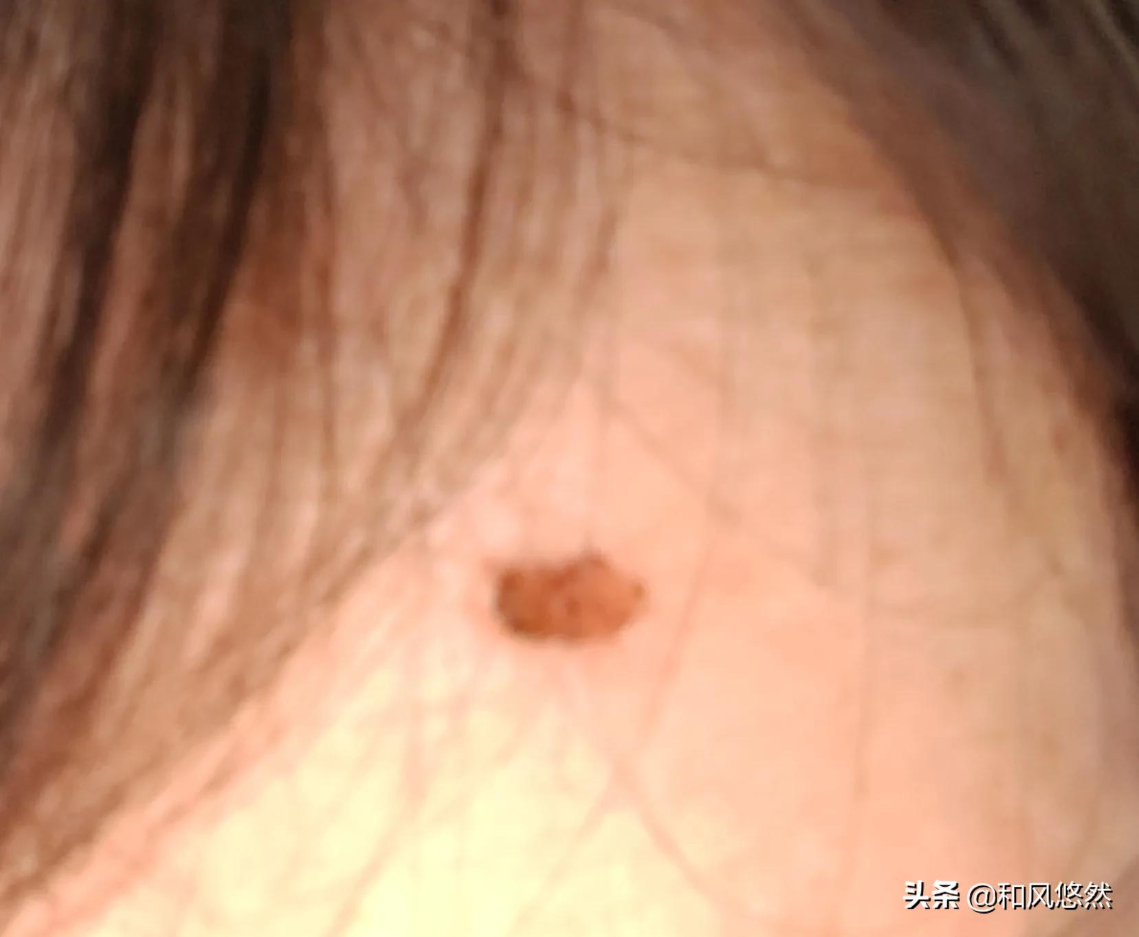 祛斑真实有效推荐,快速祛斑易出现哪些副作用