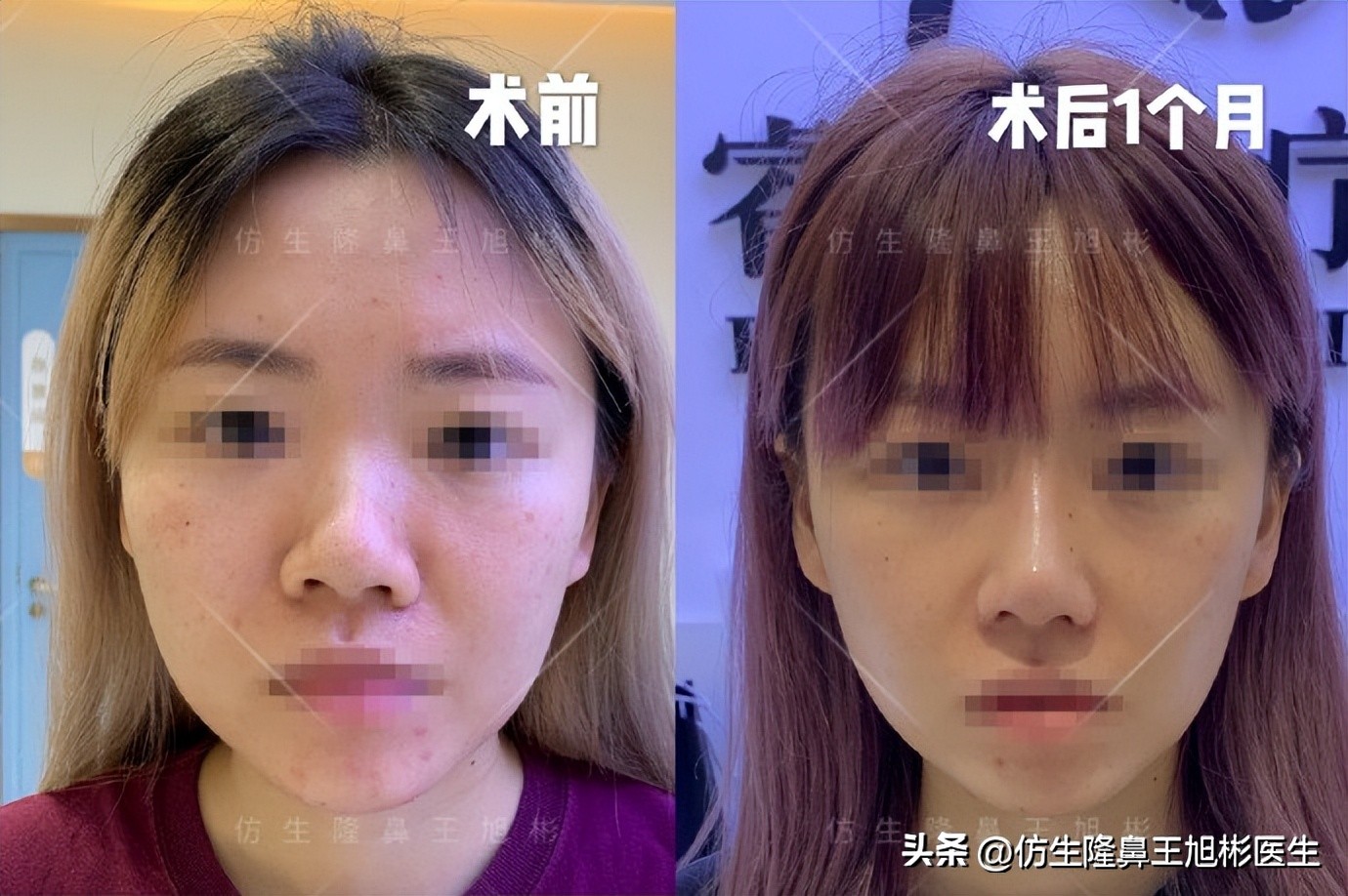 短鼻延长,短鼻塌鼻可以逆袭变长吗