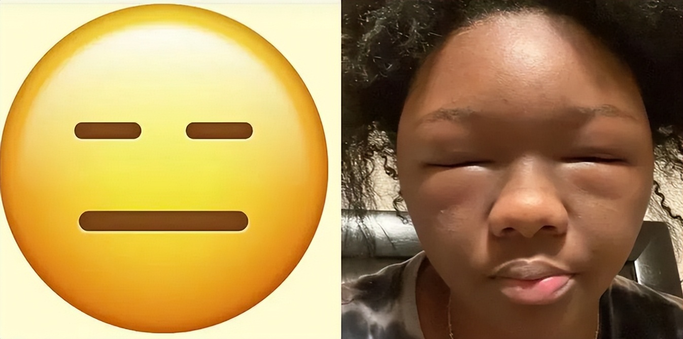 美国妹子染头发过敏全脸肿成emoji，不光失明还险些窒息
