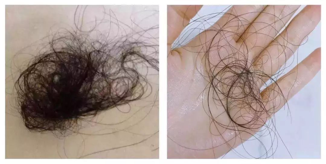 头发稀疏细软喝什么中药改善,头发细软稀疏出油如何改善