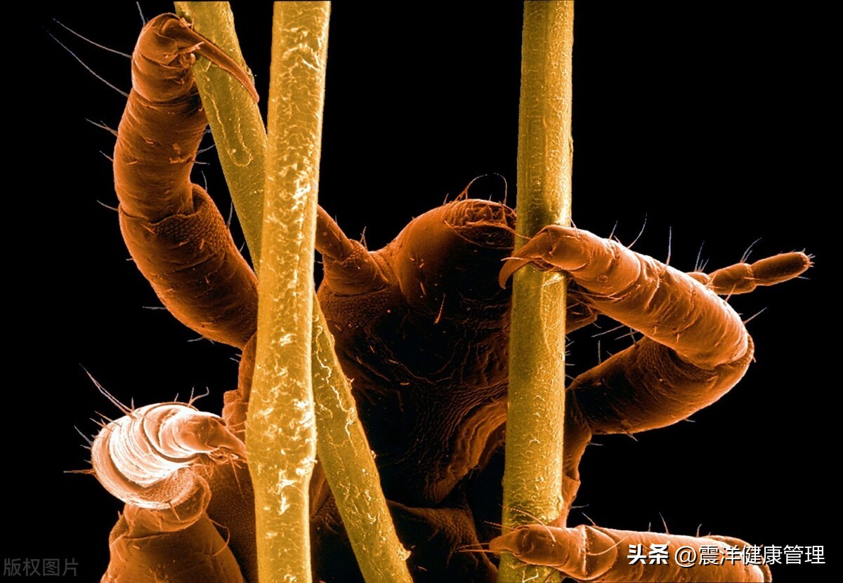 阴虱是什么原因发生的,阴虱是什么为什么会得阴虱