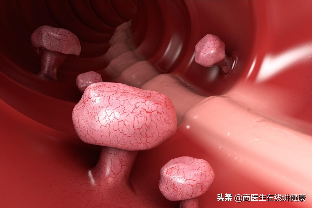 为什么会有肠道息肉,为什么肠道会长息肉