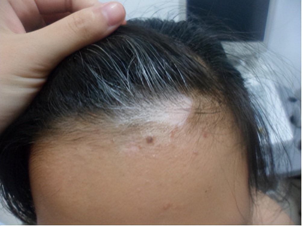 汗毛变白是不是已经变成白癜风了,毛囊型的白癜风会导致毛发变白么