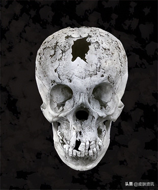 梅毒的起源和历史,历史上梅毒的起源