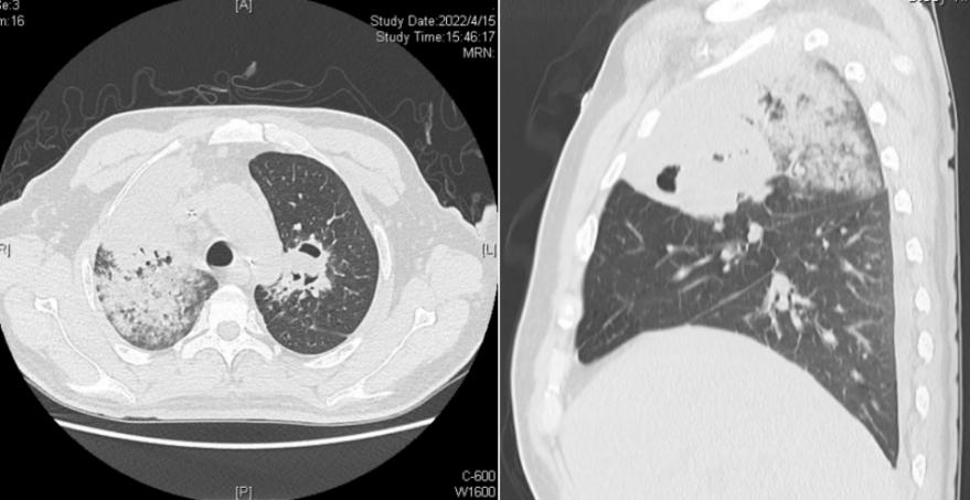 病死率和致死率,病死率20%