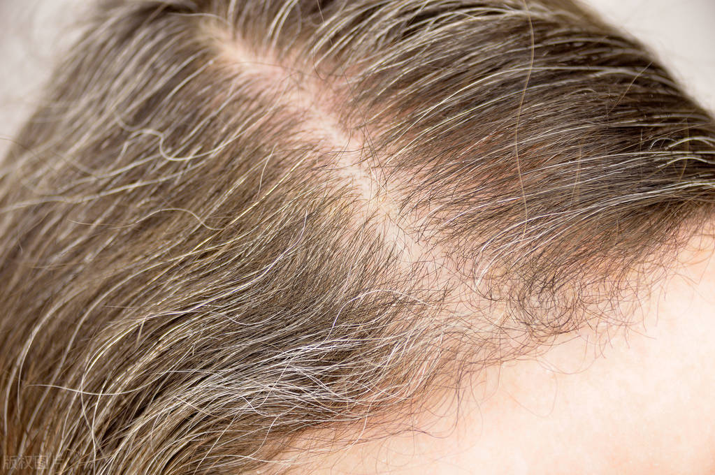 白头发是缺乏什么营养呢,白头发越长越多是缺什么营养