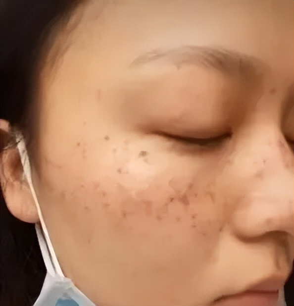 老年斑和色素沉着怎么区分,老年斑和色素沉着怎么治