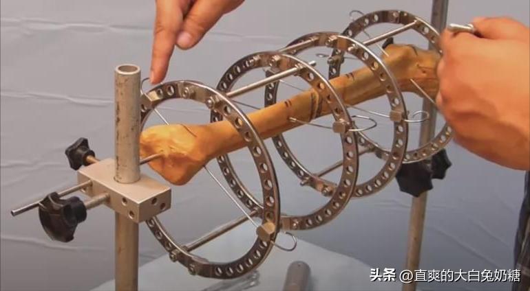 李亚诺断骨增高怎样了,断骨增高手术的李亚诺现状