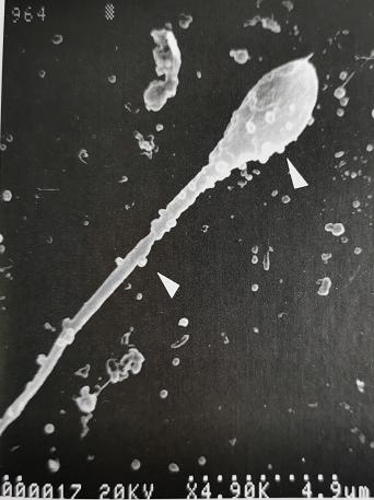 uu感染是什么意思,uu感染严重吗