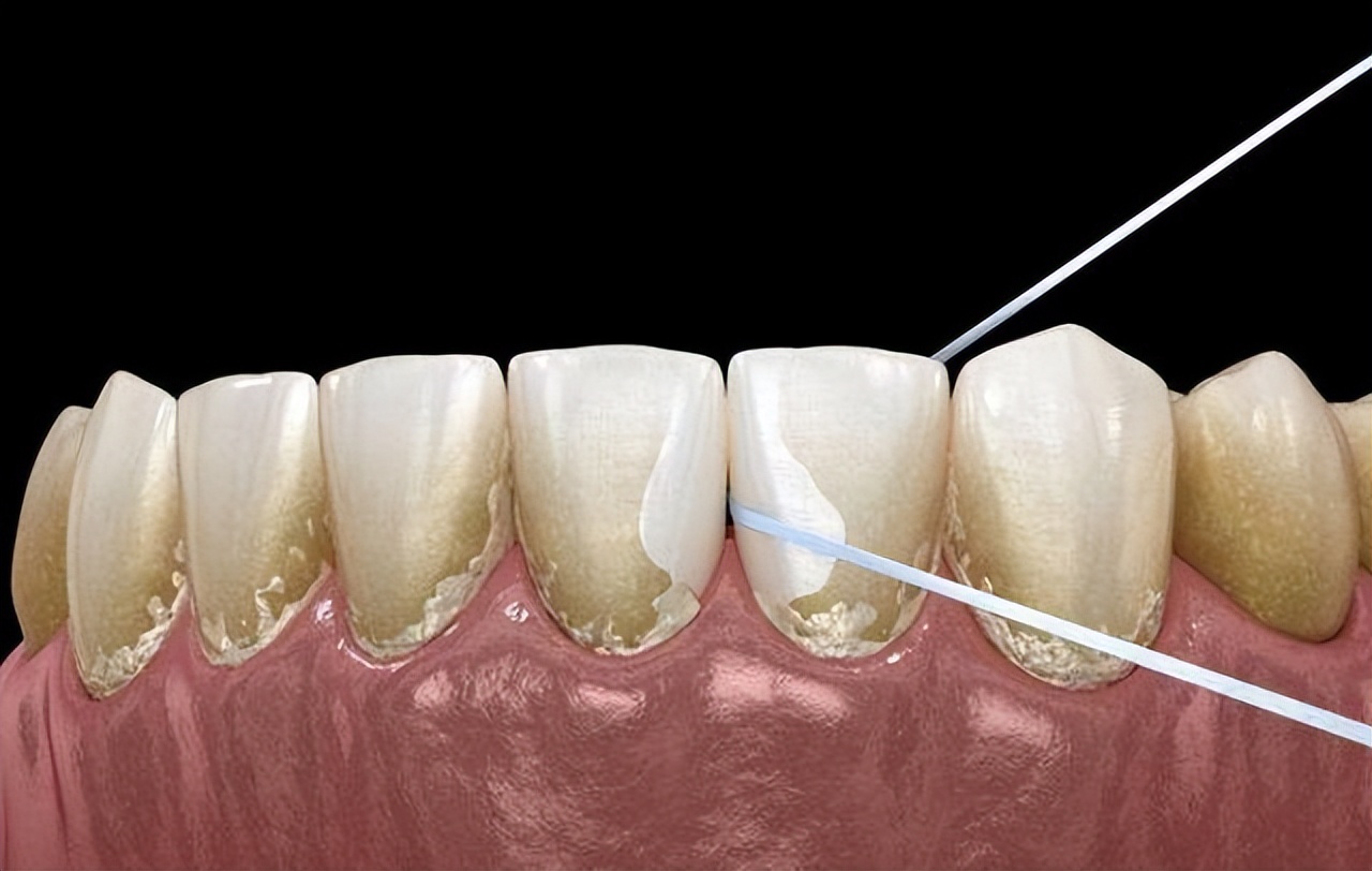 牙结石能直接抠下来吗,为什么牙结石可以用手抠出来