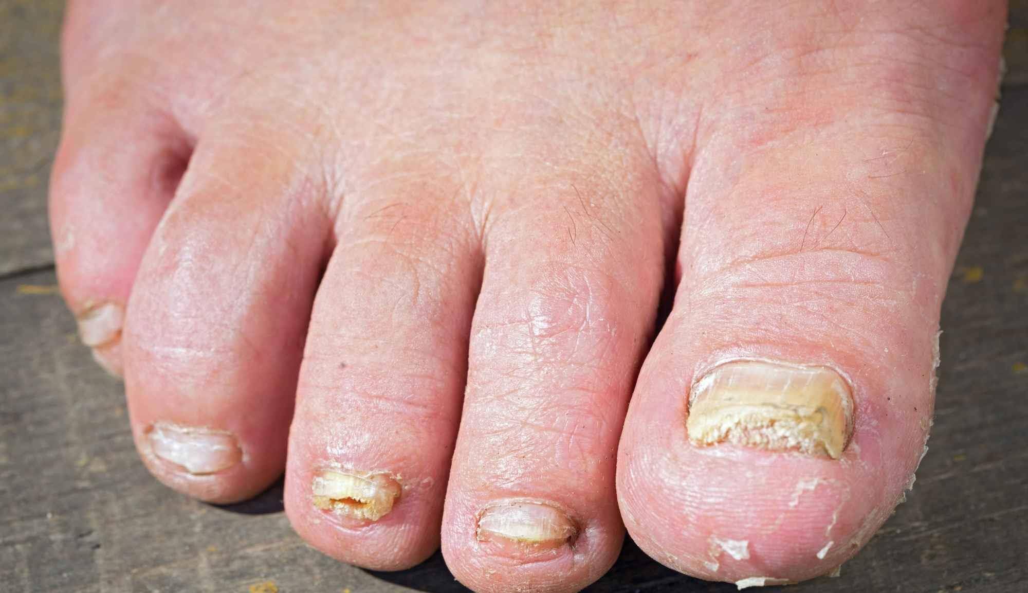 灰指甲穿凉鞋不好看怎么办,穿凉鞋得灰指甲