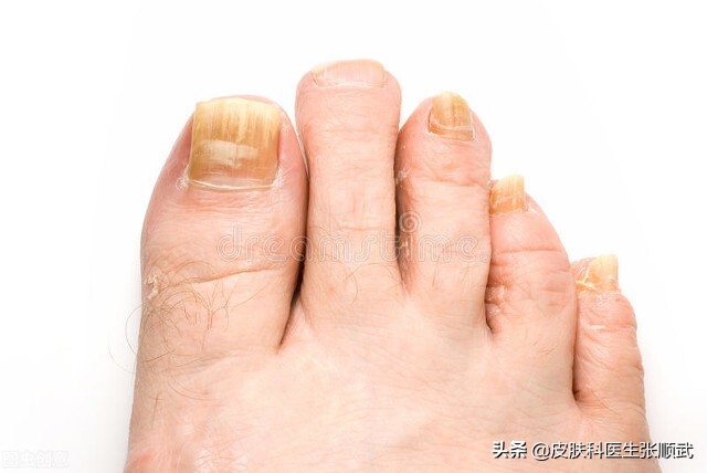 灰指甲老不好,这种方法教给大家?