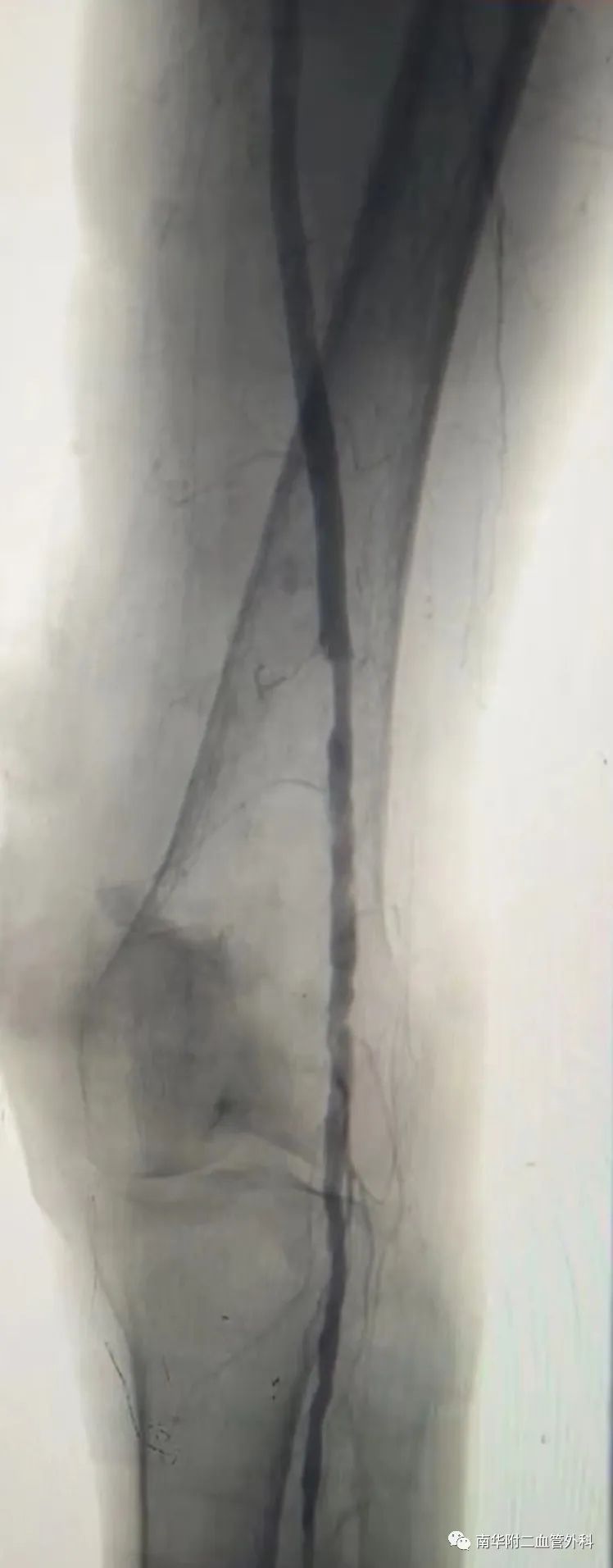 下肢血管闭塞介入治疗视频,动脉血管狭窄的最新介入治疗方法