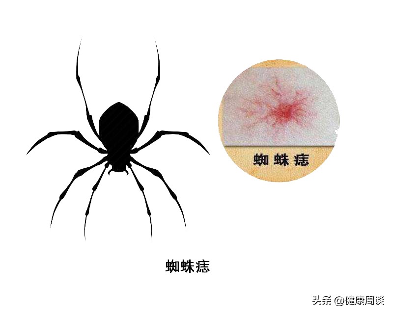 免疫系统疾病身上会长小红点,身上小红点各种疾病对应图片