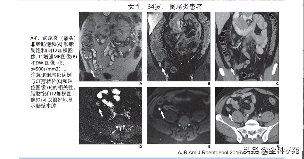 阑尾炎的讲解,关于阑尾炎的讨论总结