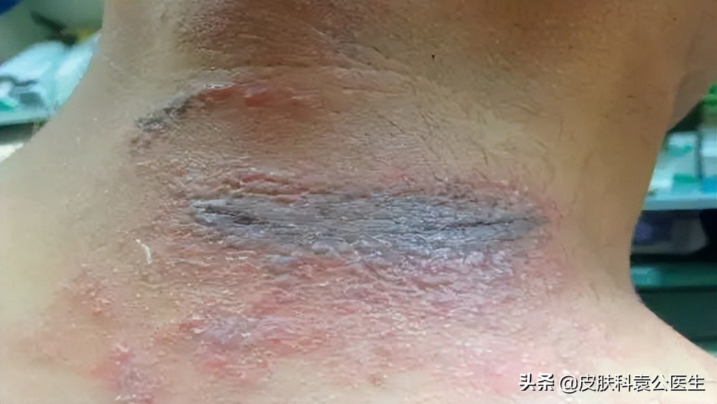 蚊虫叮咬引起的皮炎一年了没好,夏季有哪些虫叮咬会红肿