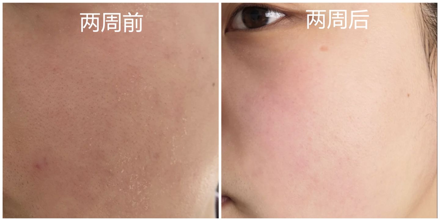 洗完澡身上痒还起皮是怎么回事,洗完澡皮肤干燥起皮浑身痒