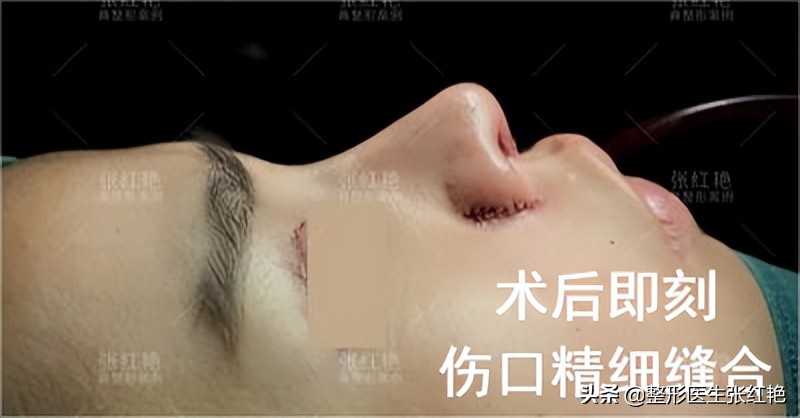 缩鼻翼怎么不留疤,缩鼻翼疤痕凸起