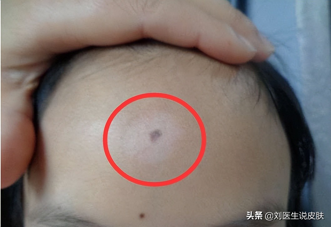 晕痣型白癜风初期和中期的区别,黑痣型白癜风怎么治