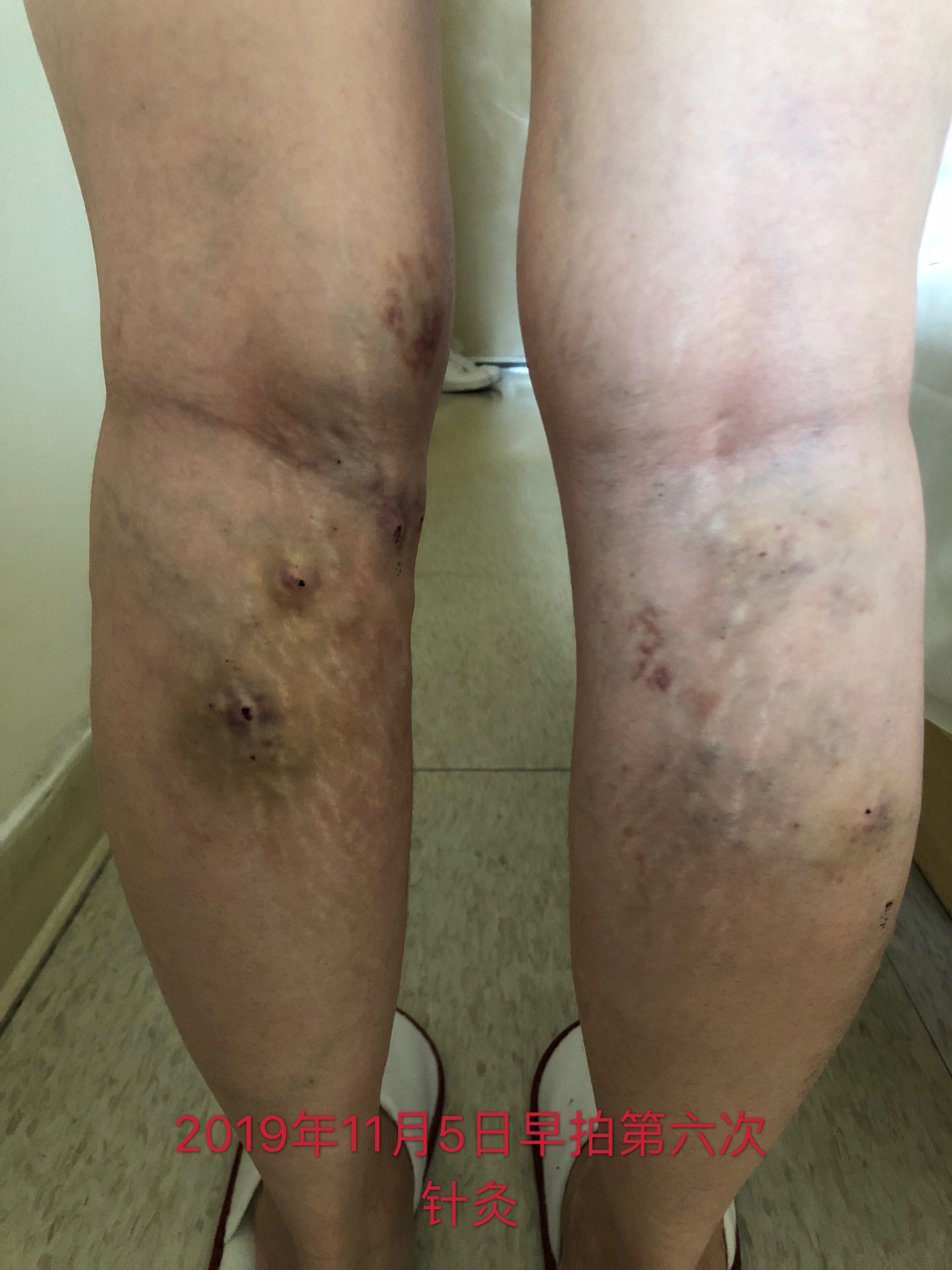 静脉曲张针灸以后为何胀痛,静脉曲张针刺疗法视频