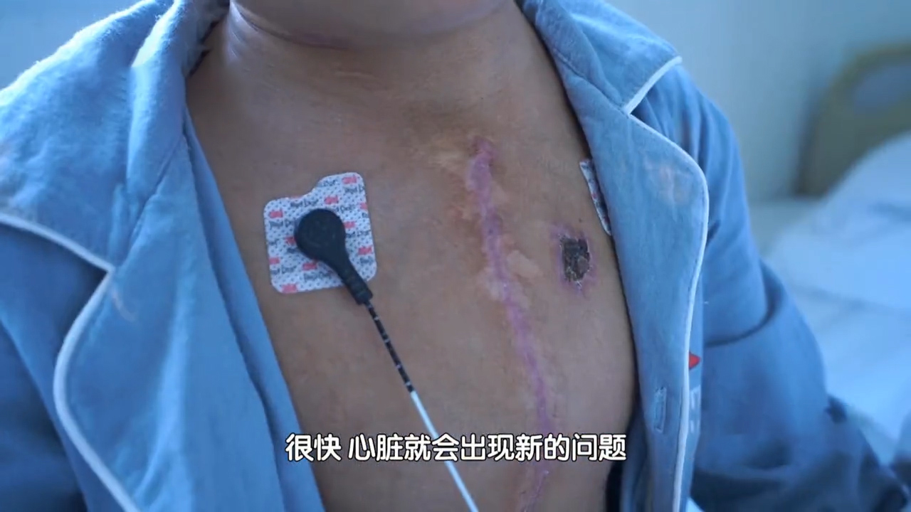 心脏发育畸形,九岁男孩经历四次心脏手术