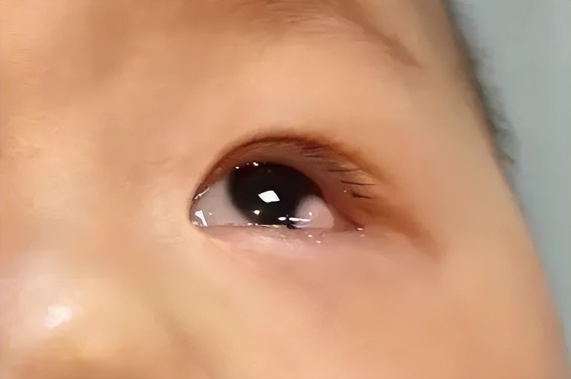 毛发上皮瘤的症状有哪些,毛发上皮瘤是怎么形成的