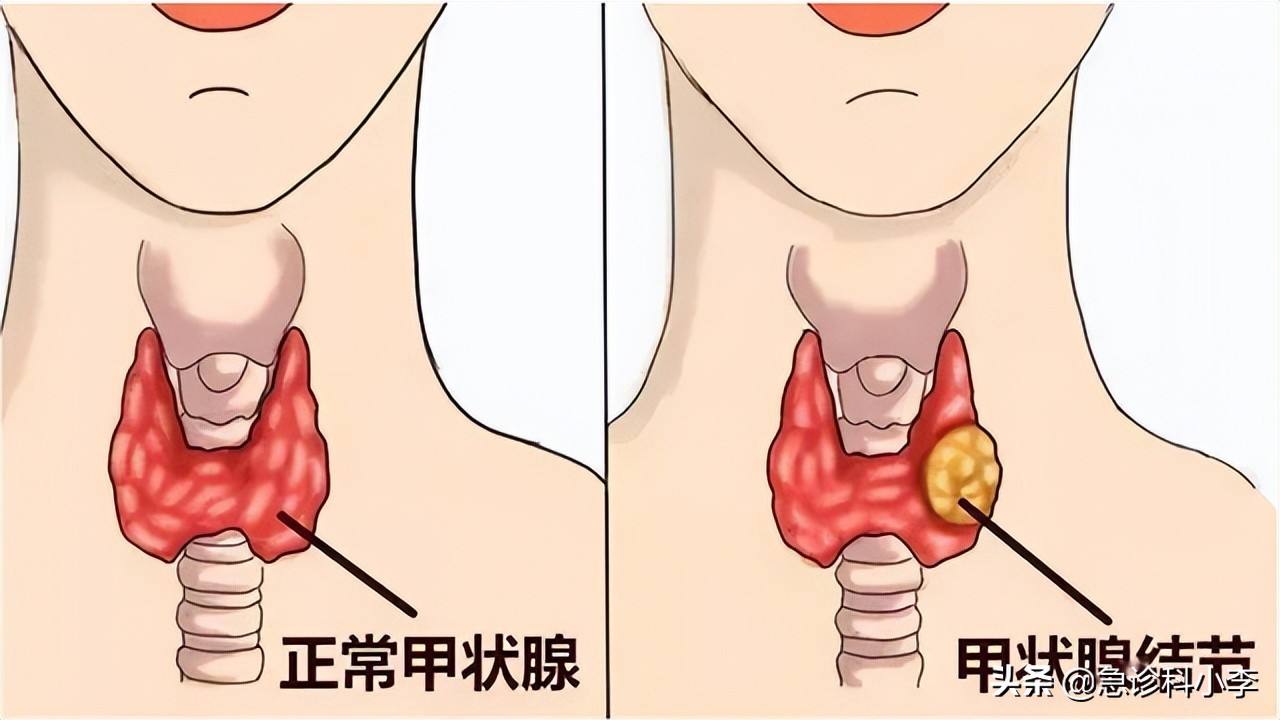 甲状腺结节伴有甲亢最好治疗方法,检查出甲状腺结节怎么办