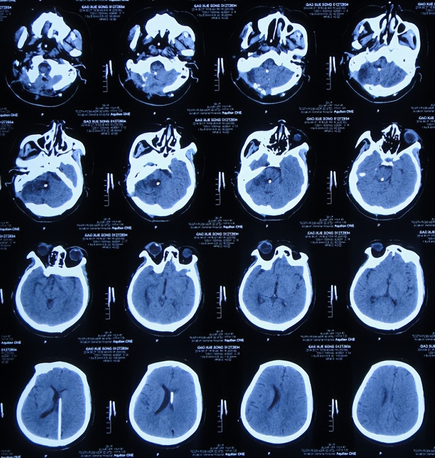 听神经瘤出现脑积水和出血,听神经瘤手术后颅压高症状