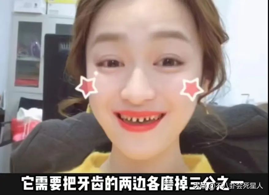 烤瓷牙有多恐怖,烤瓷牙害我一生