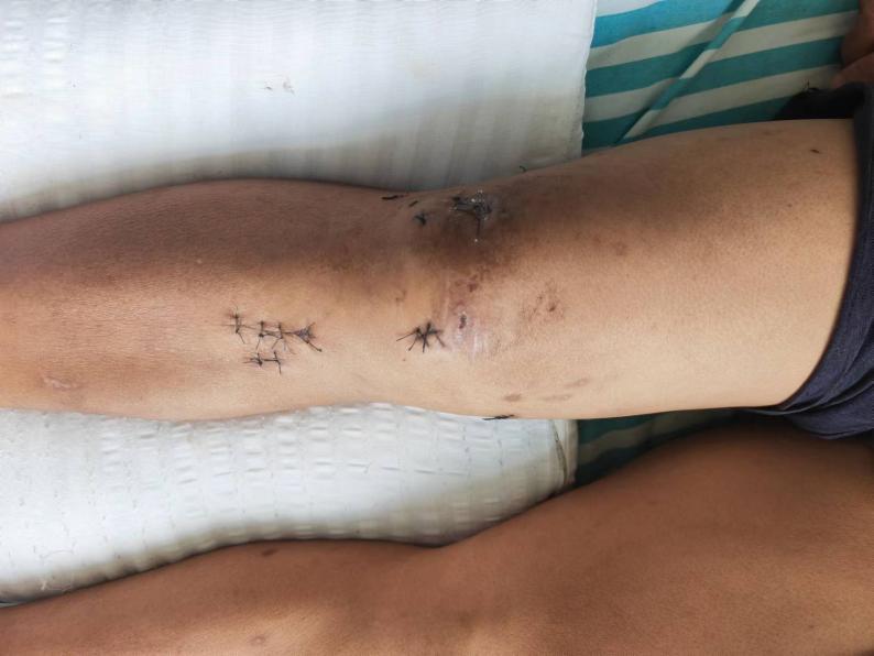 微创小切口治疗,医院的小微创手术都有什么