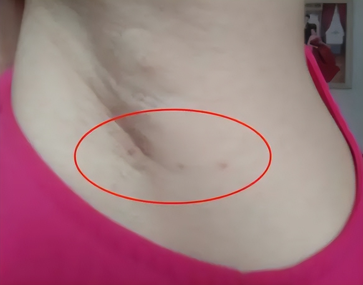 脖子腋下的小肉粒是什么,脖子腋下长小肉粒可以用手揪掉吗